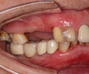 long missing teeth