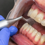 dental cleaning