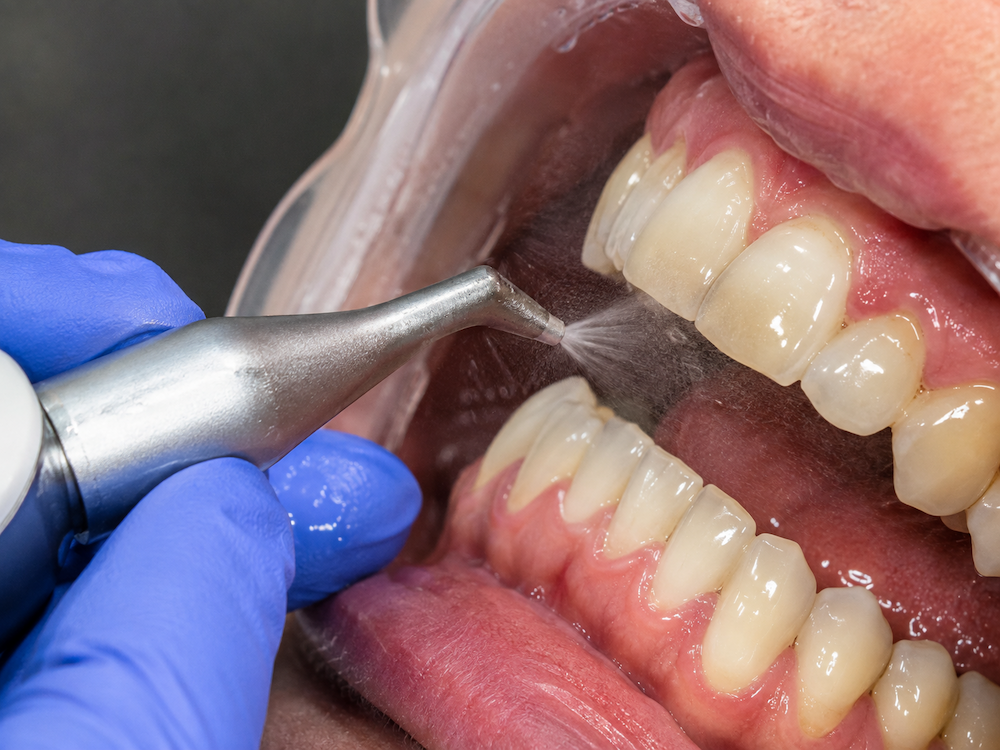 dental cleaning