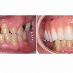 upper jaw All-on-6 dental implants