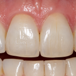 craze lines teeth