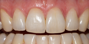 craze lines teeth