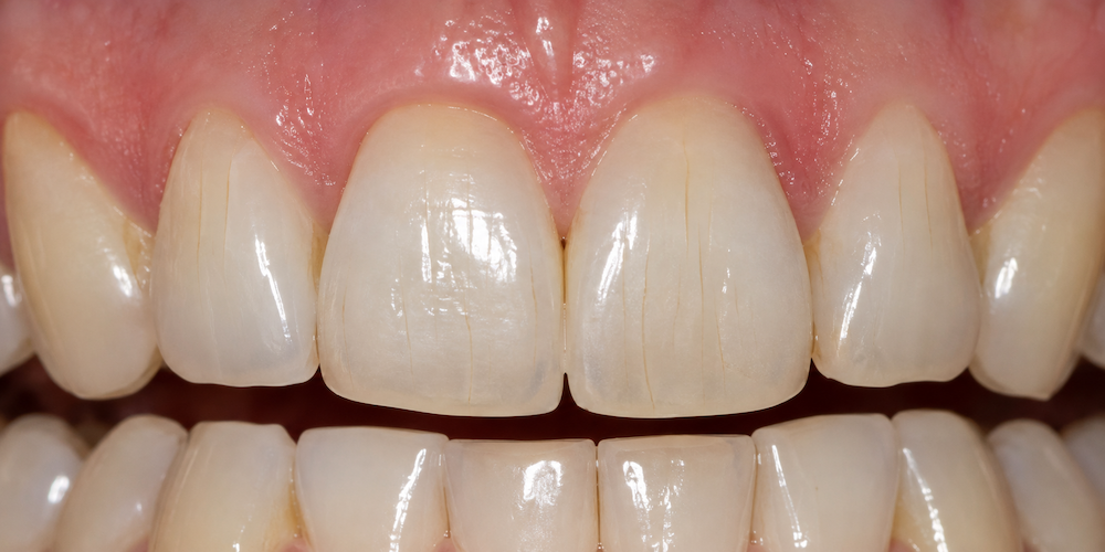 craze lines teeth