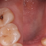 What Does a Cavity Look Like