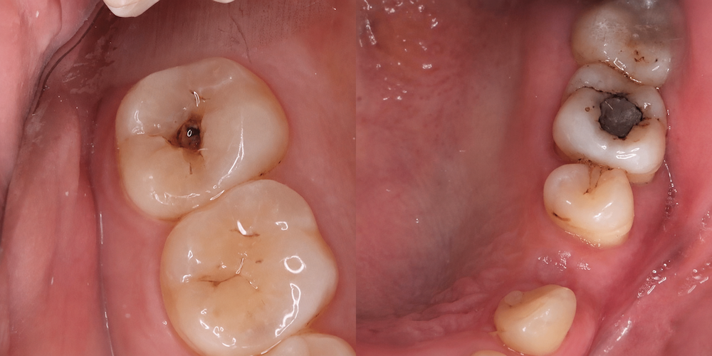 What Does a Cavity Look Like