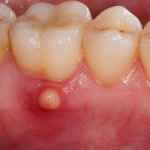 tooth abscess