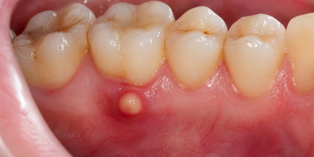 tooth abscess