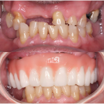 upper jaw All-on-6 dental implants (1)