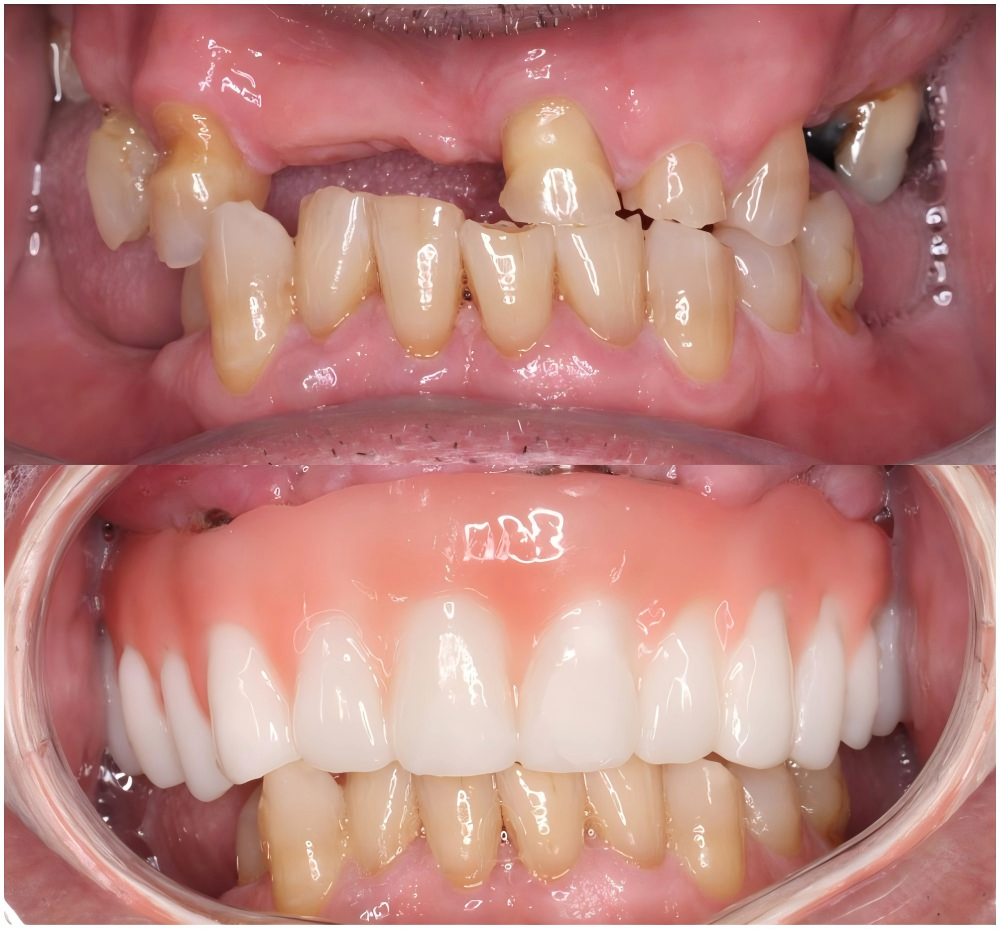 upper jaw All-on-6 dental implants (1)