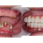 full mouth dental implants before and after