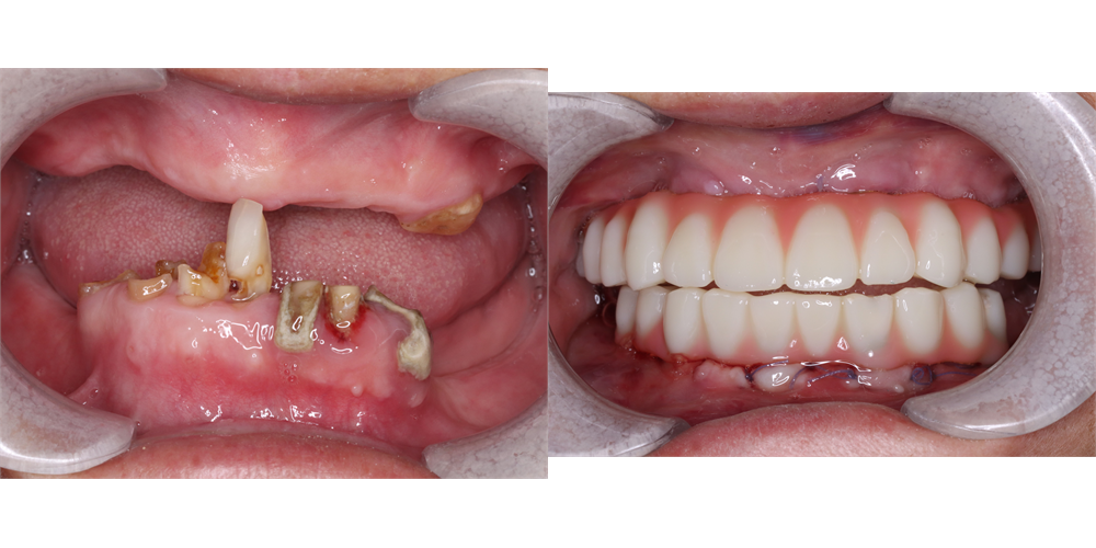 full mouth dental implants before and after