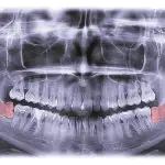 Patients really worry about 3rd-molar surgeries