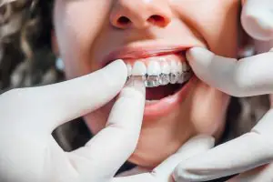 What is coming for clear aligners in 2026 and beyond