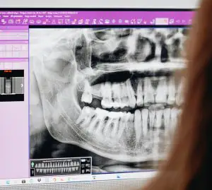 dental implants price