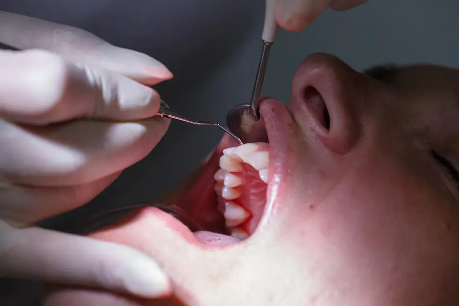 Patient at dentists office, getting soft-tissue probed and teeth cleaned of tartar and plaque, preventing periodontal disease. Dental hygiene, painful procedures and prevention concept.