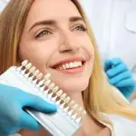 dental veneers