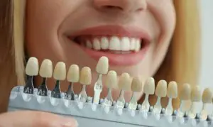 veneers