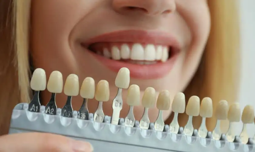 veneers