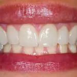 Dentists share more thoughts on the Miss Thailand viral veneer moment