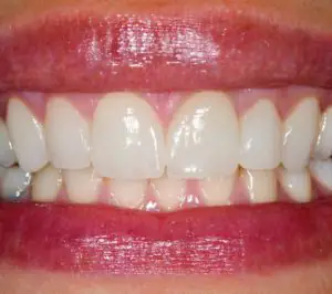 Dentists share more thoughts on the Miss Thailand viral veneer moment
