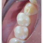 Efficiency meets aesthetics: Advancements in bulk flowable composite technology