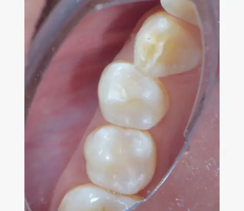 Efficiency meets aesthetics: Advancements in bulk flowable composite technology