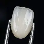 Why veneers really fall off, and what to tell patients who saw the Miss Thailand video