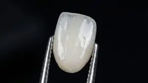 Why veneers really fall off, and what to tell patients who saw the Miss Thailand video