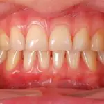 healthy tooth