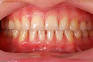 healthy tooth