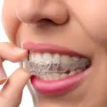 retainer teeth