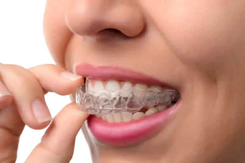 retainer teeth