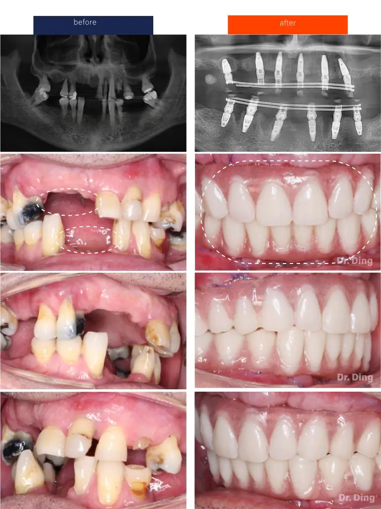 All-on-6 Dental Implants before and after