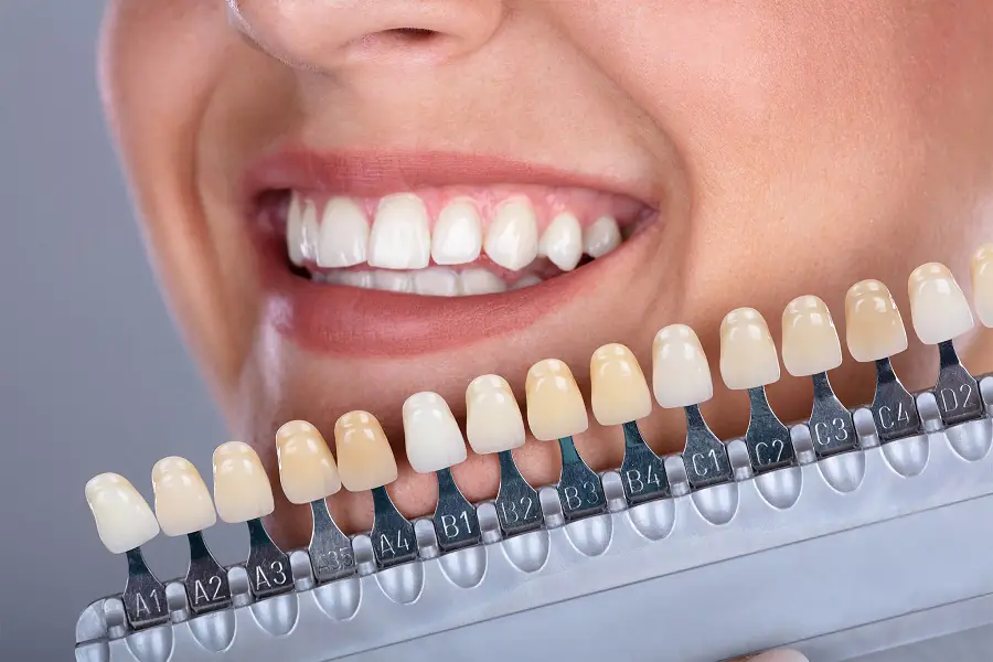 dental veneers