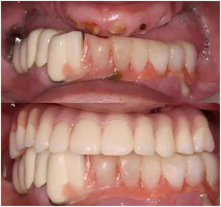 dental implants for senior case