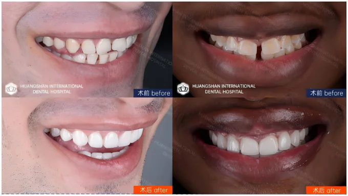Veneers for gap teeth case