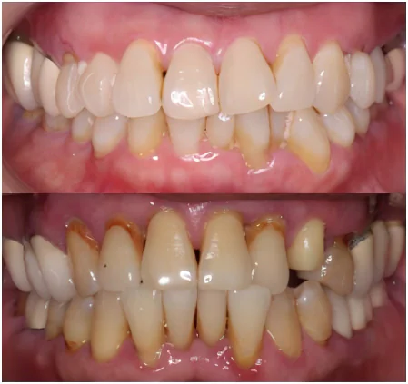 periodontal disease