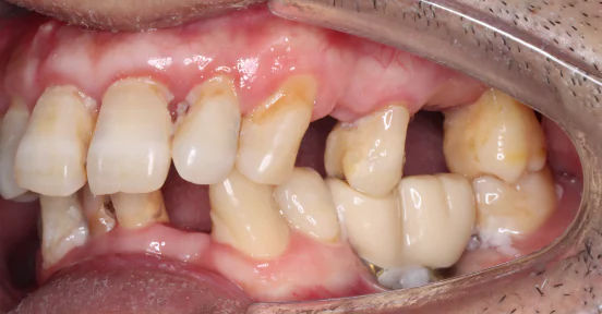 bad smell from dental implant