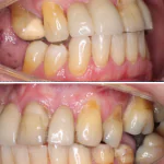 periodontal disease symptoms