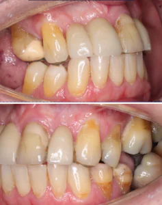 periodontal disease symptoms