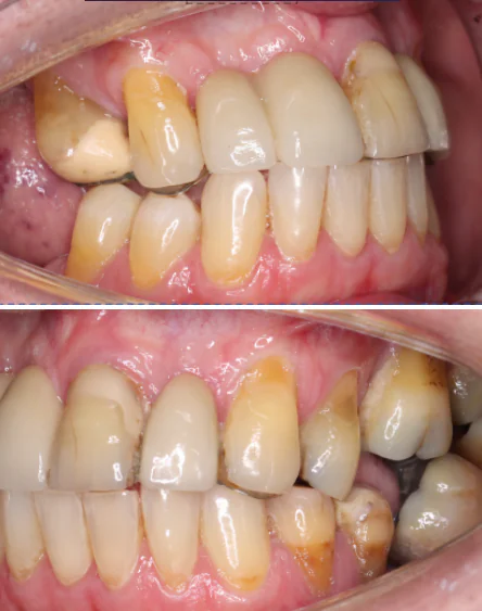 periodontal disease symptoms