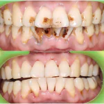 smokers teeth before and after