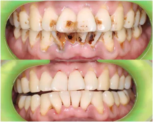 smokers teeth before and after