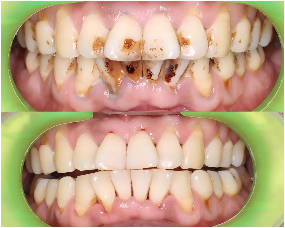 smokers teeth before and after