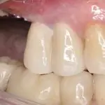 dental implants for multiple teeth