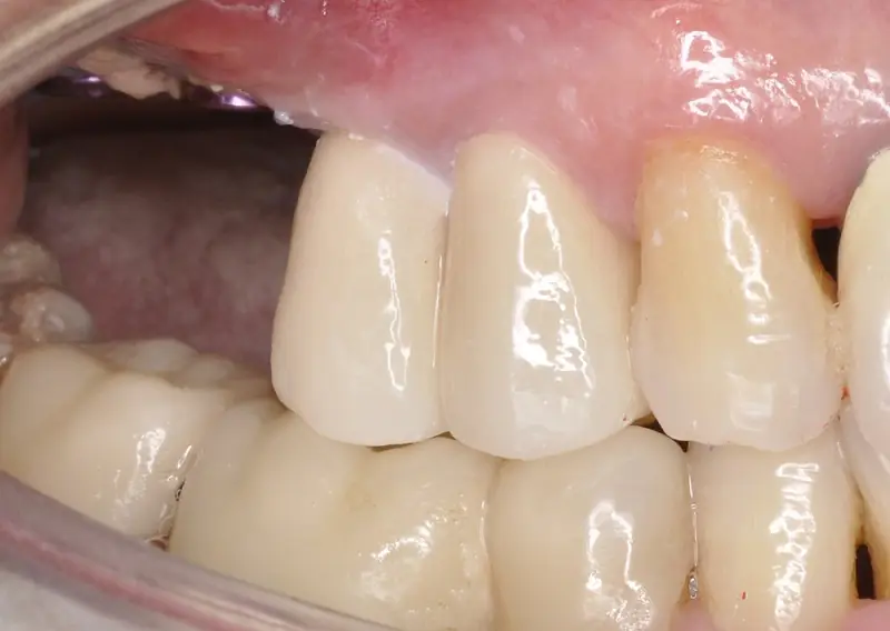 dental implants for multiple teeth