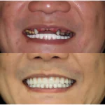 Same-Day Dental Implants Case