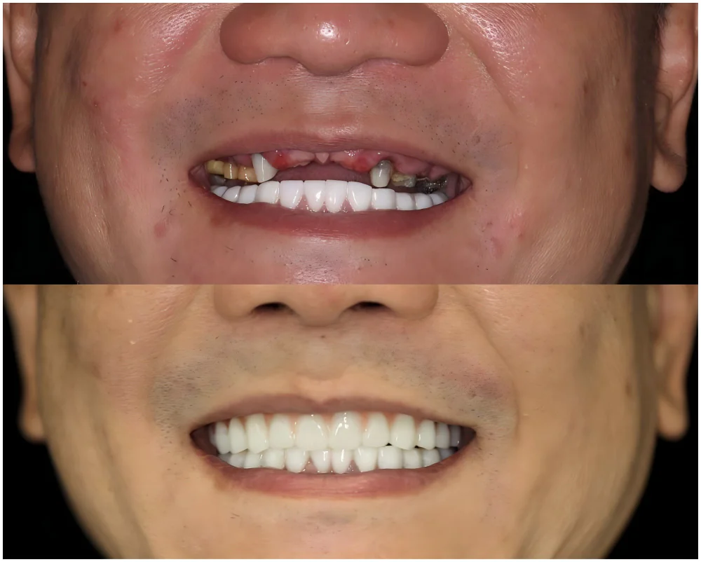 Same-Day Dental Implants Case