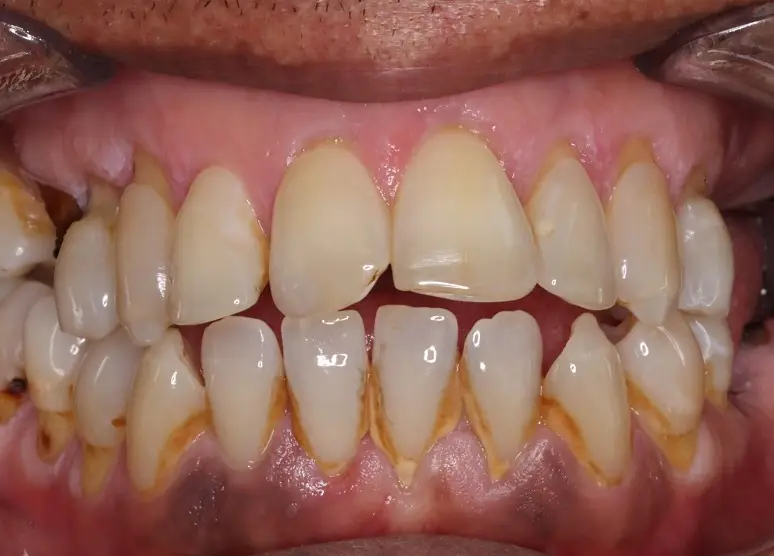 dental calculus case