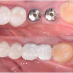 dental implants case